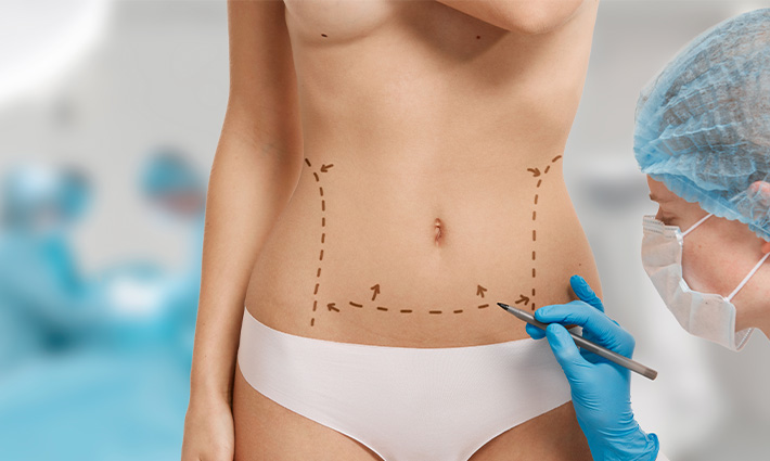Chirurgie de la silhouette