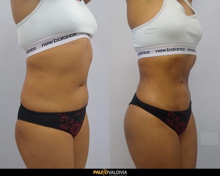 Abdominoplastie en Tunisie : pour qui, et quels résultats ?