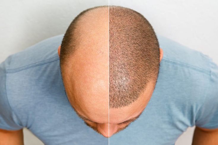 Greffe de cheveux en Tunisie : prix, techniques et résultats
