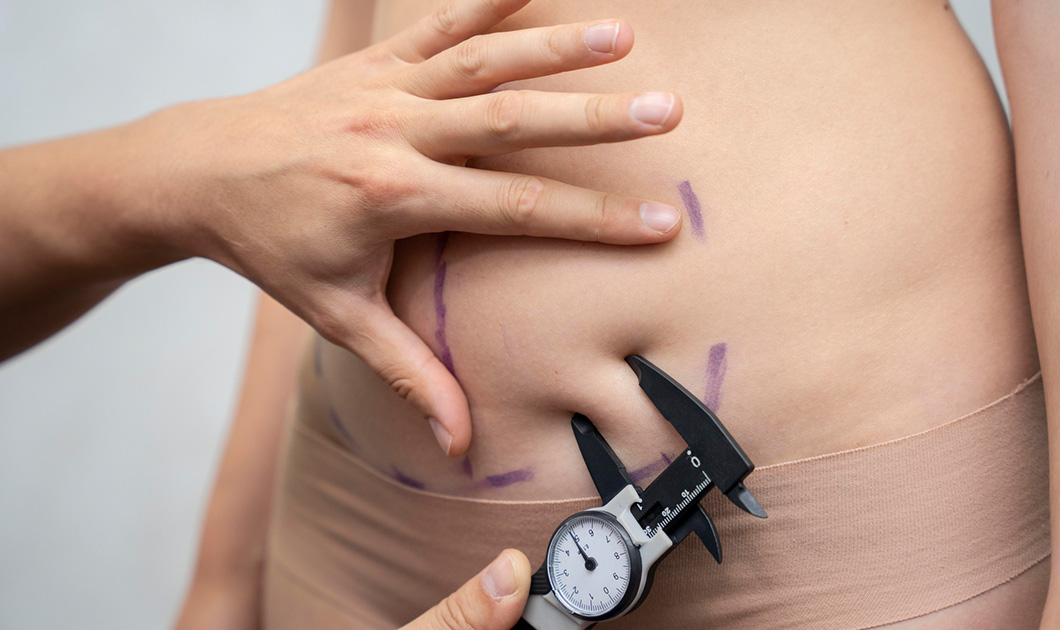 Chirurgie de l’obésité